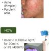 PDT gel PDT acne therapy