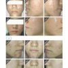 PDT gel PDT acne therapy before after