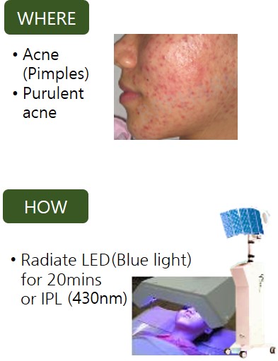 PDT gel PDT acne therapy