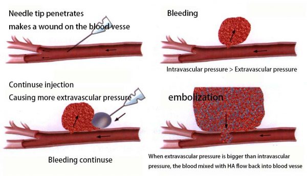 The Risk of DIY filler and treatment for complication