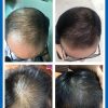 LLLT Laser Hair Growth Cap before and After